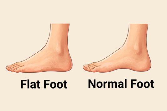 Flat Feet Explained
